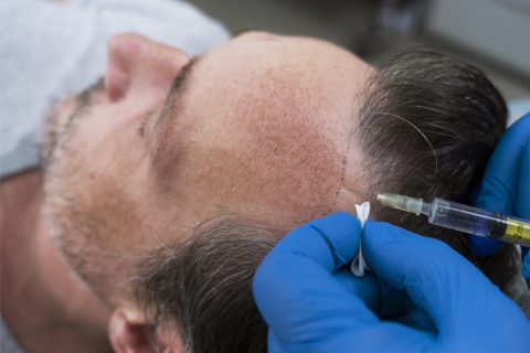 Hair Transplantation
